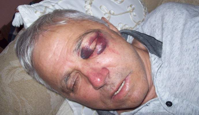 Zvornik: Umro Nezir Dardagan koji je pretučen na Bajram prije četiri godine